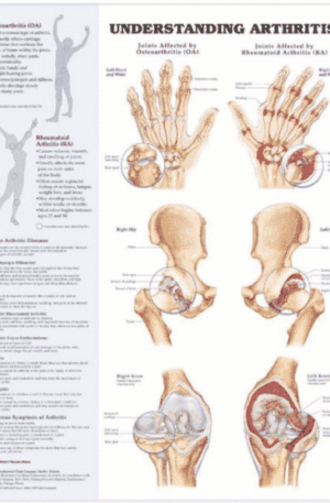Arthritis chart