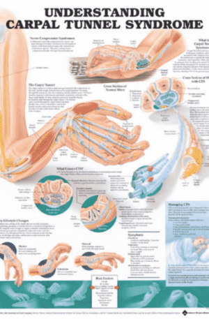 Carpal tunnel chart