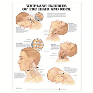 Whiplash injuries of head and neck Chart