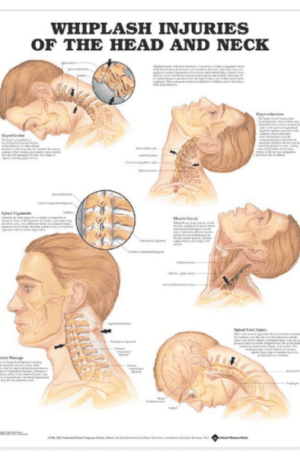 Whiplash injuries of head and neck Chart